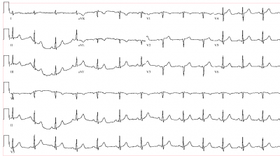 EKG_atypical_for_AMI